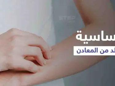 ما هي حساسية الجلد من المعادن وأهم أعراضها وطرق العلاج - وكالة ستيب نيوز