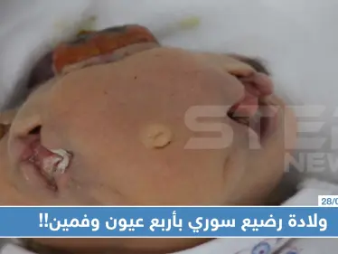 حالة نادرة: ولادة رضيع سوري بأربع عيون وفمين!! - وكالة ستيب نيوز