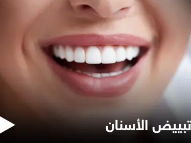 تبييض الأسنان في المنزل وأبرز أنواعه الطبية - وكالة ستيب نيوز
