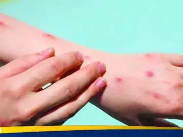 الصحة العالمية ترفع حالة الطوارئ بشأن جدري القرود - وكالة ستيب نيوز