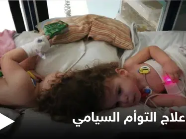 في حالة طبية نادرة.. نجاح علاج التوأم السيامي التركي وقدرتهما على المشي ومصادر تكشف التفاصيل - وكالة ستيب نيوز