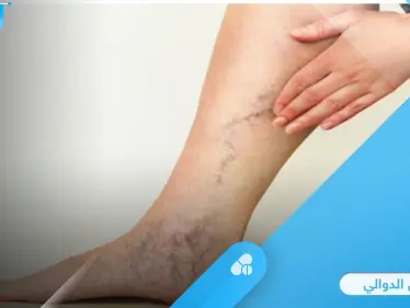 ما هي الدوالي وأسبابها الأعراض الشائعة وطرق علاجها إليك أهم المعلومات - وكالة ستيب نيوز