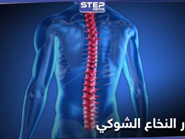 تعرف على مرض ضمور النخاع الشوكي أسبابه ومراحل خطورته على حياة الإنسان - وكالة ستيب نيوز