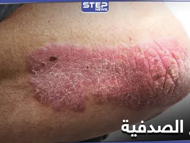 أثر النظام الغذائي على علاج الصدفية.. أنواعها وطرق الوقاية منها - وكالة ستيب نيوز