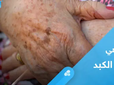 بقع الكبد.. ما هي ومتى تستدعي القلق - وكالة ستيب نيوز