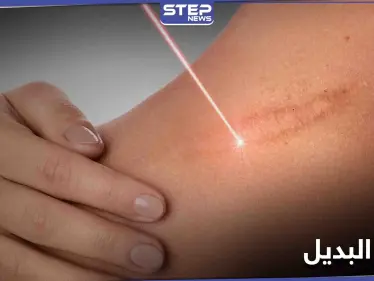 مسدس طبي.. اختراق يولد جلداً بديلاً ويغطي الحروق - وكالة ستيب نيوز