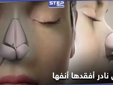 مرض نادر أصابها فأصبحت بلا أنف والأطباء يكشفون الأعضاء المعرضة لهذا التلف - وكالة ستيب نيوز