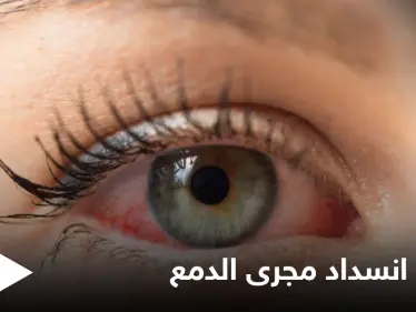 علاج انسداد مجرى الدمع لدى البالغين وأهم المعلومات عنه - وكالة ستيب نيوز