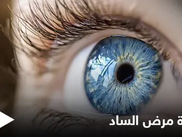 أكثر أمراض العين خبثاً.. ما هو مرض الساد وماهي أسبابه إليك التفاصيل - وكالة ستيب نيوز
