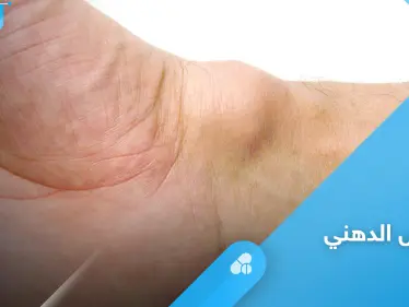 الكيس الدهني.. هل هو خطير وأبرز أعراضه وعلاجه إليك أهم المعلومات - وكالة ستيب نيوز