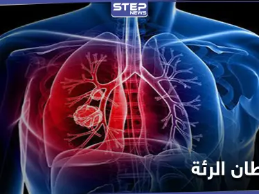 علامة تظهر في منطقة العين تدلُّ على الإصابة بـ سرطان الرئة.. إليك التفاصيل - وكالة ستيب نيوز