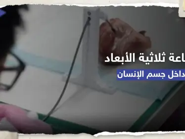 إنجاز علمي.. طباعة ثلاثية الأبعاد داخل جسم الإنسان - وكالة ستيب نيوز