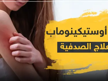 دواء أوستيكينوماب لعلاج الصدفية - وكالة ستيب نيوز