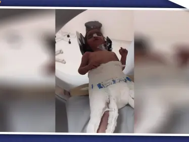 إهمال طفل مهجّر في مشفى الباب، ورفض تركيا إدخاله تتسبب بفقدانه أطرافه وبصره!! - وكالة ستيب نيوز