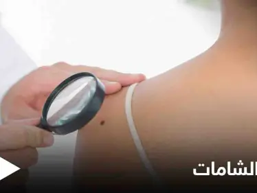 ماهي الشامة وهل لها علاقة بسرطان الجلد تعرف على أنواعها - وكالة ستيب نيوز