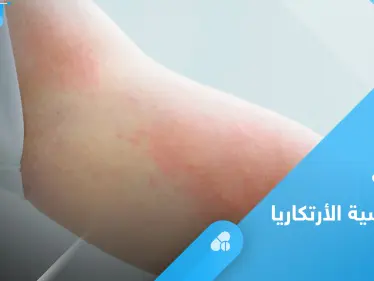 ما هي حساسية الأرتكاريا.. تعرف على أسبابها وأبرز طرق العلاج - وكالة ستيب نيوز