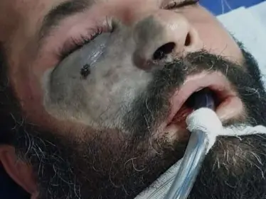 مصر تصدر بياناً بشأن تطورات الإصابة بـ الفطر الأسود.. ورئيس لجنة الصحة يناشد المواطنين - وكالة ستيب نيوز