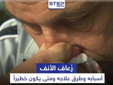 متى يكون رُعاف الأنف خطيراً .. أسبابه وطرق علاجه - وكالة ستيب نيوز