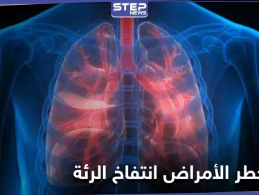 من أعراضه ضيق التنفس والإرهاق المستمر تعرف على مرض انتفاخ الرئة وطرق علاجه - وكالة ستيب نيوز