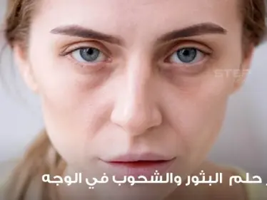 تفسير رؤية البثور والشحوب في المنام في الوجه وفي جميع أنحاء الجسم - وكالة ستيب نيوز