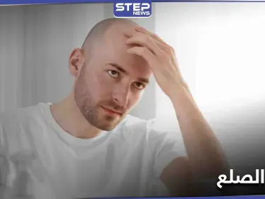 تمهيداً لعلاج الصلع.. العلماء يكشفون السبب الذي يثبّط نشاط بصيلات الشعر - وكالة ستيب نيوز