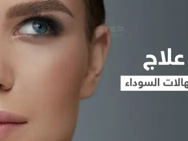 علاج الهالات السوداء "ازرقاق تحت العين" في المنزل وبطرق طبية إليك أهم المعلومات - وكالة ستيب نيوز