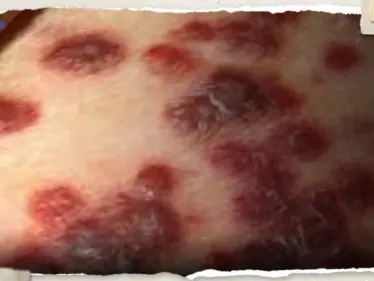 أمريكا تُحذّر من بكتيريا خطيرة آكلة للحوم.. إليك أبرز أعراضها - وكالة ستيب نيوز