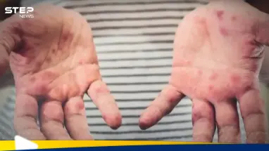 كندا في صدارة الأمريكتين.. حصيلة قياسية للحصبة: أحدث الأخبار