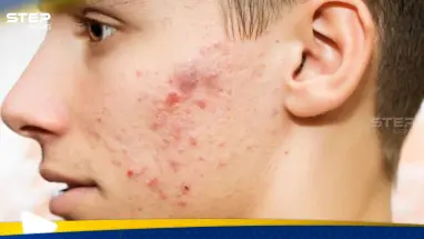 حب الشباب في الشتاء… لماذا يزداد ظهوره وكيف يمكن السيطرة عليه؟