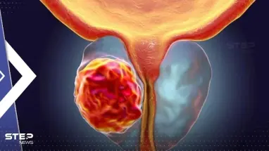 باحثون يكشفون لأوّل مرّة عن إنزيم يمكن استهدافه لقتل سرطان البروستات