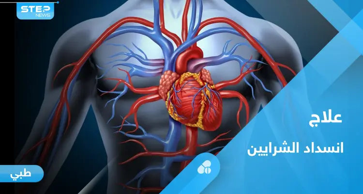 علاج انسداد الشرايين والأوعية الدموية بوسائل طبيعية: أخبار