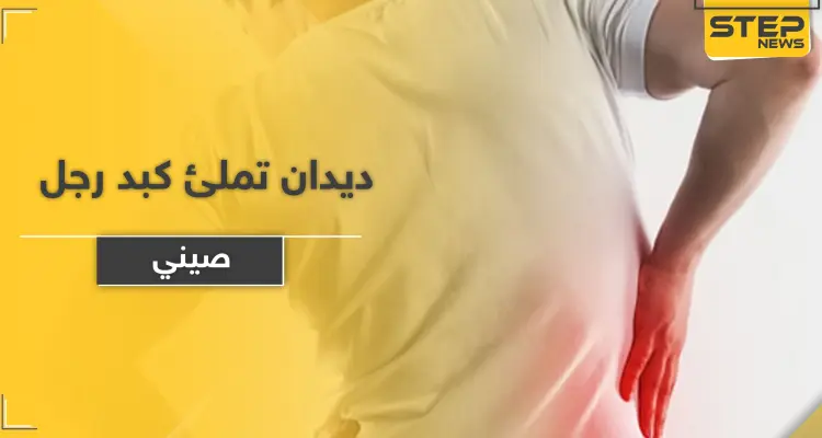 بالصور|| ديدان تملئ كبد رجل صيني.. والأطباء يضطرون لإستئصال جزء كبير منه ويوضحون الأسباب: أخبار