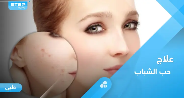 وصفات طبيعية لعلاج حب الشباب تعرف عليها: أخبار