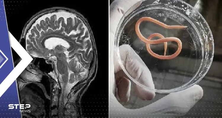 حالة طبية هي الأولى في العالم.. دودة ثعبان حية في دماغ مريضة: أخبار