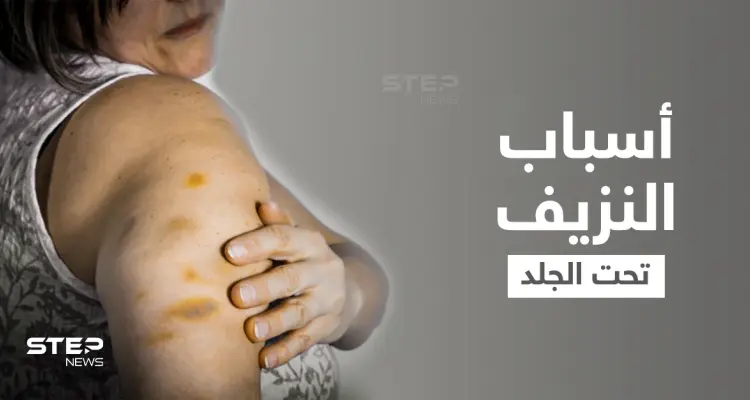 نزيف تحت الجلد... علامات أرجوانية أشبه بالكدمات على الجسم ما هي أسبابها وطرق علاجها: أخبار