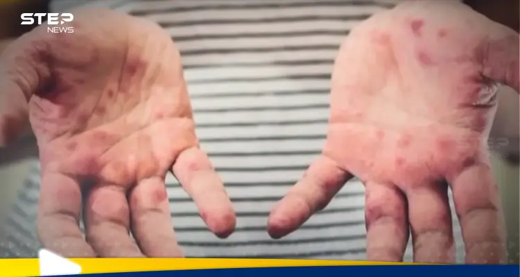 كندا في صدارة الأمريكتين.. حصيلة قياسية للحصبة: أخبار