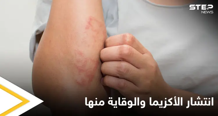 هل تنتشر الأكزيما في الجسم.. وطرق الوقاية منها إليك أهم المعلومات: أخبار