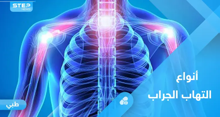 التهاب الجراب وآلام المفاصل.. كل ما عليك معرفته: أخبار