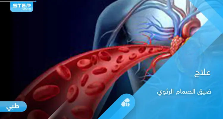 خطورة ضيق الصمام الرئوي وطرق العلاج.. إليك أهم المعلومات: أخبار