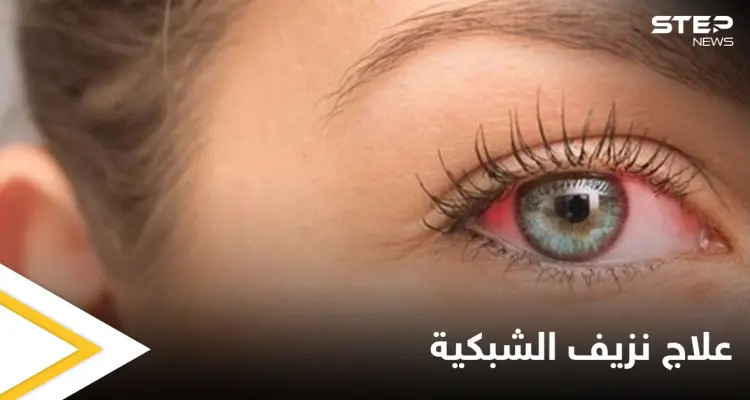 تعرف على علاج نزيف الشبكية بالحقن وطرق أخرى: أخبار