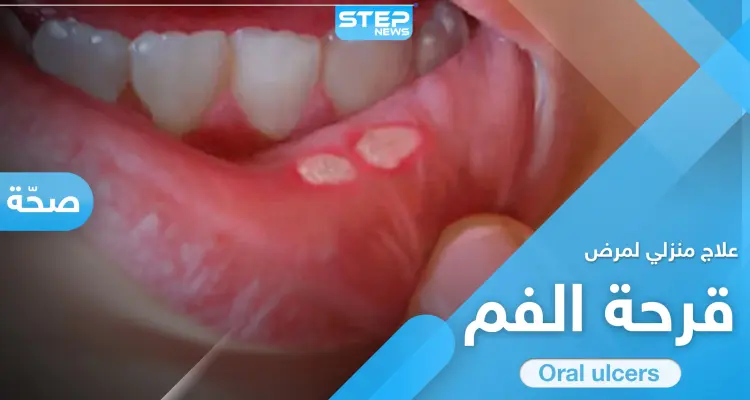 علاج قرحة الفم في المنزل.. إليك الطريقة و7 نصائح هامة: أخبار