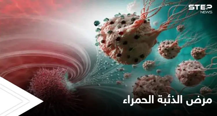في الشهر العالمي لمكافحته.. تعرف على مرض الذئبة الحمراء وخطورته وأنواعه الشائعة: أخبار