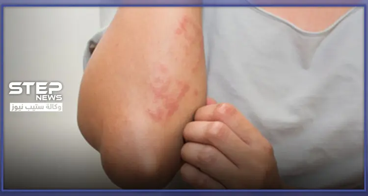 لوراتادين الجيل الـ 2 من مضادات مستقبلات الهيستامين.. الاستطبابات والجرعة الدوائية: أخبار