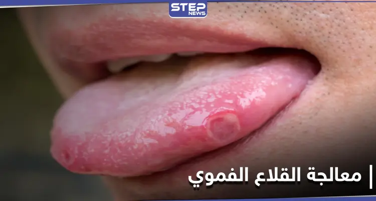 علاجات منزلية مذهلة للتخلص من القلاع الفموي بشكل طبيعي.. إليك 4 طرق: أخبار