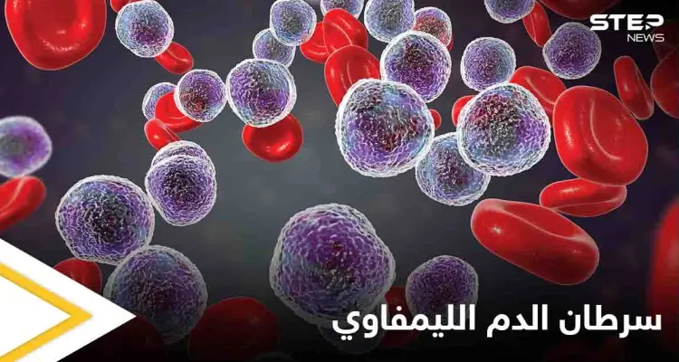 ما هو سرطان الدم الليمفاوي وكيف تظهر أعراضه على المريض إليك أهم المعلومات: أخبار