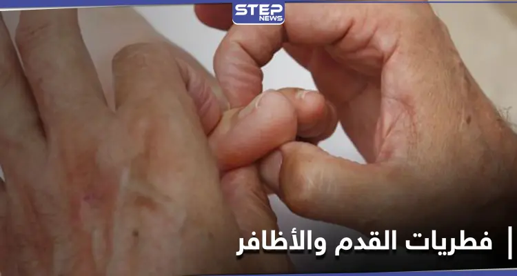 لإيقاف خطر الإصابة بمرض فطريات القدم والأظافر.. إليك 7 نصائح لمكافحته: أخبار