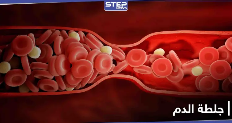 أعراض جلطة الدم وأخطارها وطرق الوقاية منها: أخبار