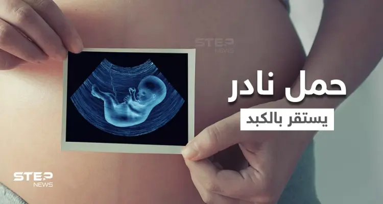 بالفيديو|| بحالة فريدة من نوعها في العالم.. حمل نادر لامرأة خارج الرحم استقر في الكبد: أخبار