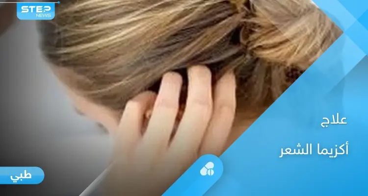 علاج أكزيما الشعر الدهنية بالأعشاب والنظام الغذائي المناسب لها: أخبار