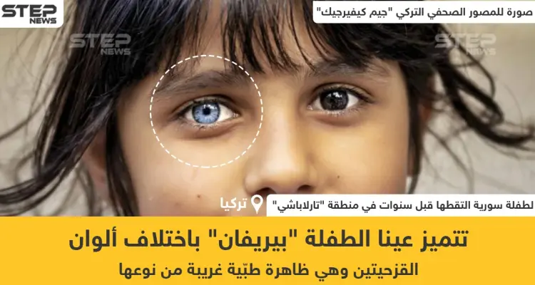 طفلة سورية تتميز باختلاف ألوان عينيها: أخبار
